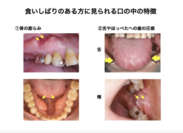 歯医者のボトックス治療ってどうなの？スタッフ体験談サムネイル